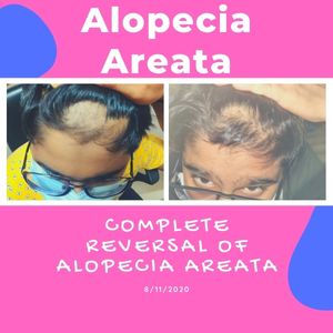 Treatment of Alopecia Areata